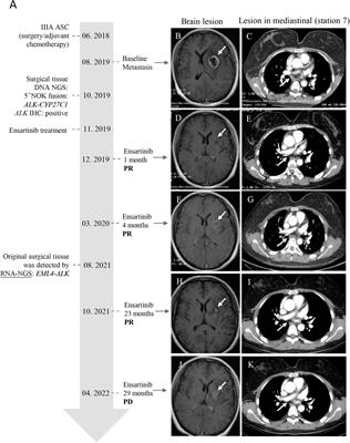 A non-functional 5′ ALK fusion validated at the RNA level as a classical EML4-ALK that responds well to the novel ALK inhibitor ensartinib: A case report